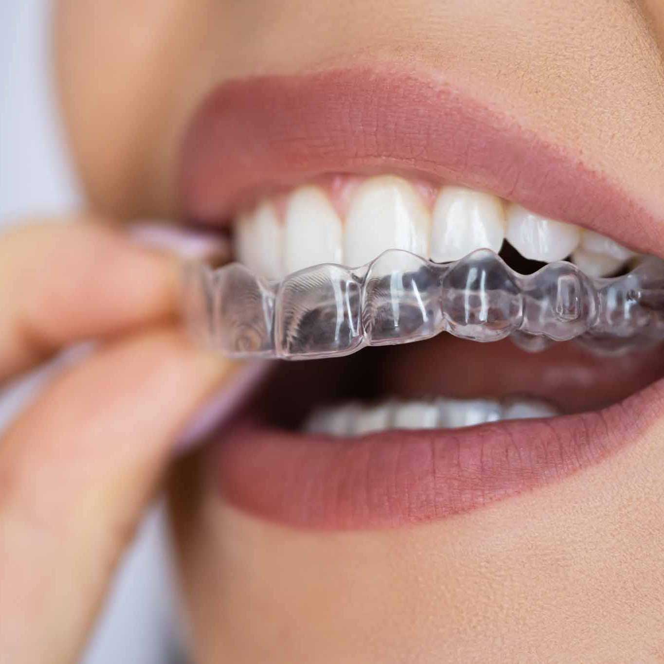Clear Aligner Treatment Steps